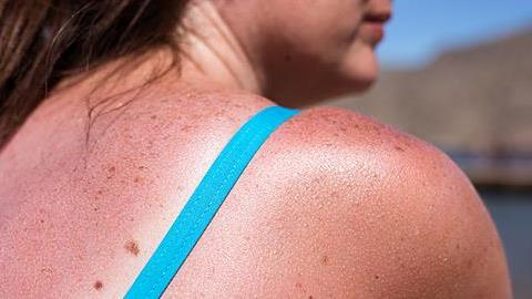 Τι να κάνετε αν έχετε καεί από τον ήλιο