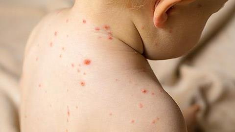 Σε ανησυχητική έξαρση η ιλαρά σε Ελλάδα και Ευρώπη τον τελευταίο χρόνο