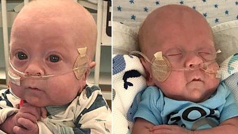 Πρόωρο μωράκι κέρδισε τη μάχη για τη ζωή όταν οι πιθανότητες να επιβιώσει ήταν 2%