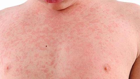 Μηνιγγίτιδα Β στα παιδιά: Τα προειδοποιητικά σημάδια που δεν πρέπει να αγνοήσετε