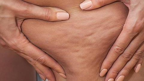 Τι να τρώτε για να μειώσετε την κυτταρίτιδα