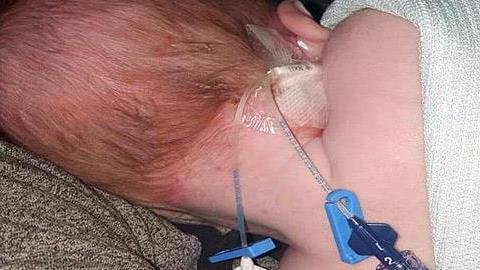 Νεογέννητο μωράκι κινδύνευσε να χάσει τη ζωή του από έρπητα