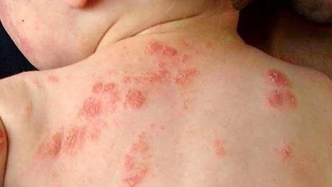 Ψωρίαση στα παιδιά: Πώς να την αναγνωρίσετε και πώς να την αντιμετωπίσετε 