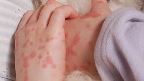 3 παιδικές ασθένειες που δεν πρέπει να αγνοήσουμε