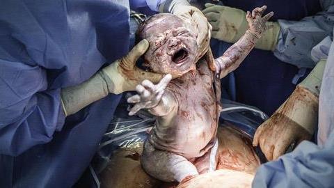 12 φωτογραφίες καισαρικής που αποδεικνύουν ότι το γυναικείο σώμα αντέχει τα πάντα