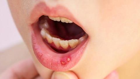 Η 4 ετών κόρη μου ταλαιπωρείται από βαριά στοματίτιδα. Τι μπορούμε να της δώσουμε;