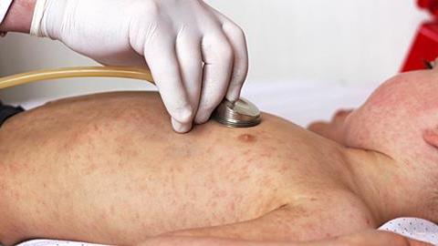 Έξαρση ιλαράς στην Ελλάδα και σε άλλες ευρωπαϊκές χώρες