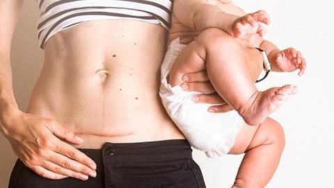 Πώς είναι πραγματικά οι 6 πρώτες εβδομάδες μετά την καισαρική 