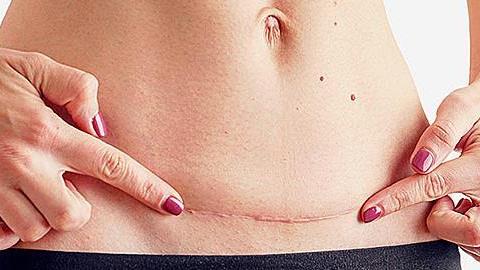 Έχω κάνει ήδη 3 καισαρικές. Είναι επικίνδυνο να μείνω ξανά έγκυος;