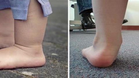 Πώς καταλαβαίνετε αν το παιδί έχει πλατυποδία