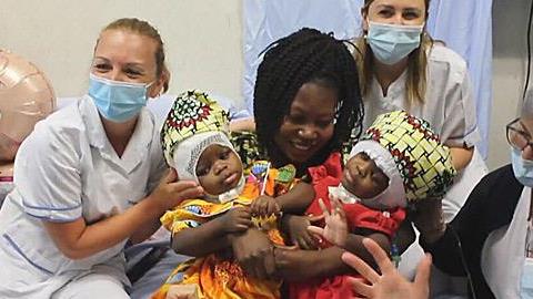 Γιατροί χωρίζουν σιαμαία δίδυμα που ήταν ενωμένα στο κεφάλι