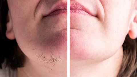 5 φυσικοί τρόποι για να περιορίσετε την ανεπιθύμητη τριχοφυΐα προσώπου