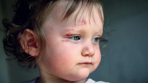 Πρώτες βοήθειες: τι κάνουμε όταν το παιδί χτυπήσει στο κεφάλι και σε ακόμη 5 επικίνδυνες καταστάσεις