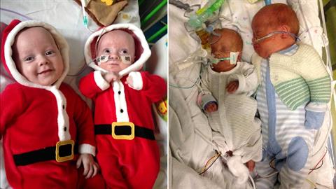 Δίδυμα γεννιούνται με σπάνιο σύνδρομο και το ένα είναι μεγαλύτερο απ' το άλλο