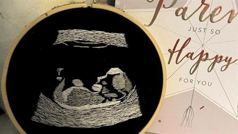 Τυφλός μπαμπάς «βλέπει» το υπερηχογράφημα του μωρού του μέσω της αφής