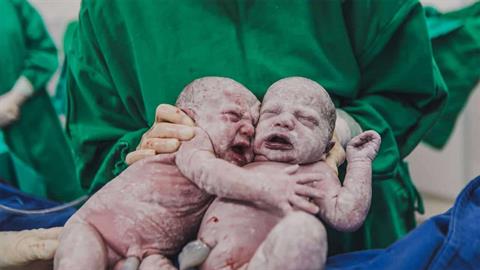 Η συγκλονιστική στιγμή που δίδυμα γεννιούνται... αγκαλιασμένα!