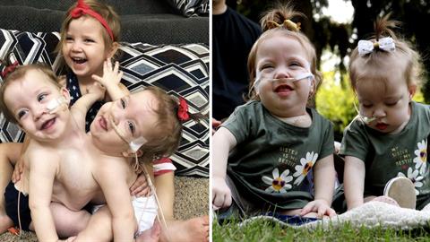 Σιαμαία κοριτσάκια που γεννήθηκαν με ενωμένη κοιλιά και στήθος, επέζησαν από θαύμα