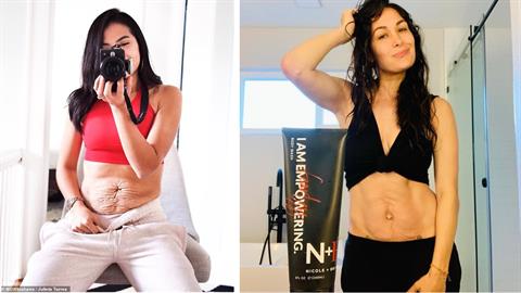 «Η κοιλιά μου μετά τη γέννα μοιάζει με τσαλακωμένη σακούλα και είμαι περήφανη!»