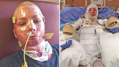 Μπαμπάς έσωσε την κόρη του από μπουκάλα με αέριο που έσκασε στο πρόσωπό της