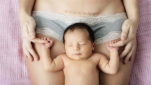 Επέλεξα να γεννήσω με καισαρική κι η πρώτη που με «δίκασε» ήταν η μαμά μου