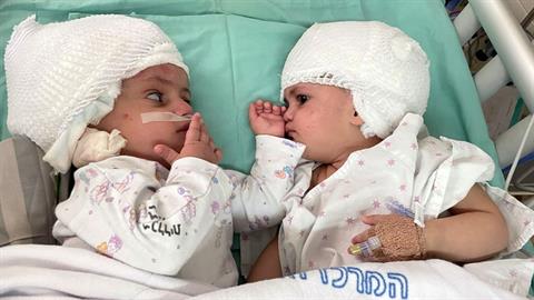 Σιαμαία κοριτσάκια κοιτάχτηκαν για πρώτη φορά μετά την επέμβαση