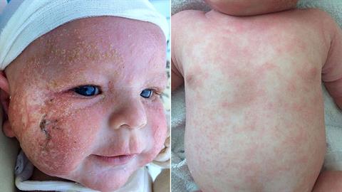 «Νομίζαμε ότι το μωρό μας είχε απλώς ξηροδερμία αλλά ήταν κάτι χειρότερο»