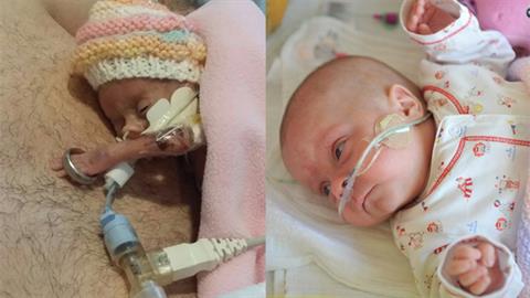 Πρόωρο μωρό γεννήθηκε τόσο μικρό που φορά τη βέρα του μπαμπά της για βραχιόλι