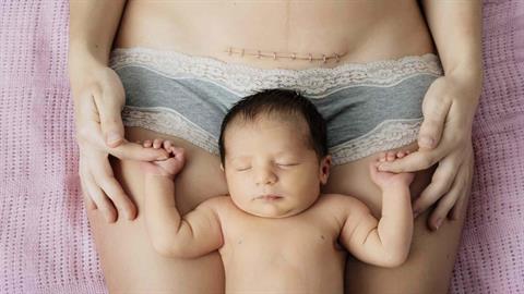 Καισαρική τομή: Συμβουλές ειδικών για γρήγορη ανάρρωση