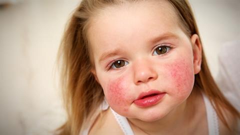 Όταν αφήνεις ένα αλλεργικό παιδί στην ευθύνη του σχολείου, ανησυχείς κάθε λεπτό