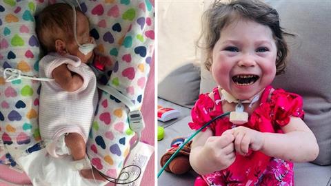 Πρόωρο μωράκι νίκησε τον θάνατο και επιβίωσε - σήμερα είναι 4 και γεμάτο χαμόγελα