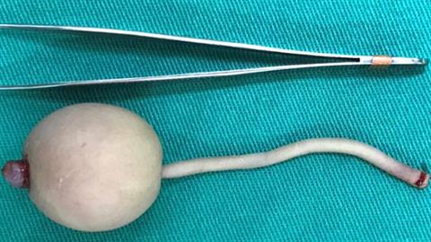 Γεννήθηκε μωρό με... ουρά 12 εκατοστών - άφησε άφωνους τους γιατρούς!