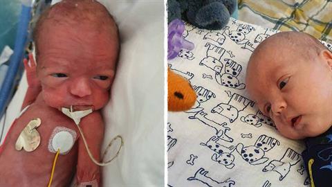 Πρόωρο μωρό με εγκεφαλική αιμορραγία επιβίωσε παρά τις ελάχιστες πιθανότητες