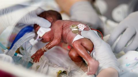 Πρόωρο μωρό που ζύγιζε λιγότερο από 400 γρ. δυναμώνει μέρα με τη μέρα