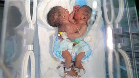 Σιαμαία δίδυμα που ήταν ενωμένα στο στήθος διαχωρίστηκαν με επιτυχία