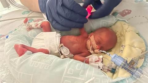 Το μωρό μου γεννήθηκε 325 γραμμάρια - ήταν τρομακτικά μικρό αλλά επιβίωσε!