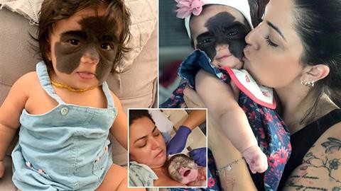 Μωρό με επικίνδυνο εκ γενετής σημάδι θα κάνει εγχείρηση που θα του αλλάξει τη ζωή