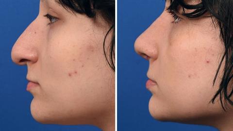 Μαμά πήγε την κόρη της να κάνει πλαστική στη μύτη για να γλυτώσει το μπούλινγκ