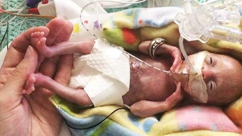 Αληθινοί μαχητές! 3 πρόωρα μωράκια που κέρδισαν το στοίχημα της ζωής