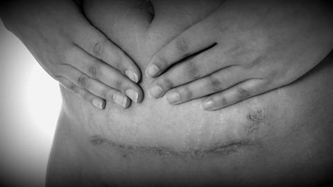 Παιδίατρος: γίνονται πολλές αναίτιες καισαρικές που κρύβουν κινδύνους