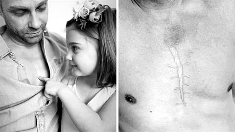 Μπαμπάς έκανε τατουάζ ίδιο με την ουλή της κόρης του για να της συμπαρασταθεί!