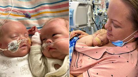 Πρόωρα διδυμάκια που γεννήθηκαν στις 22 εβδομάδες νίκησαν τον θάνατο!