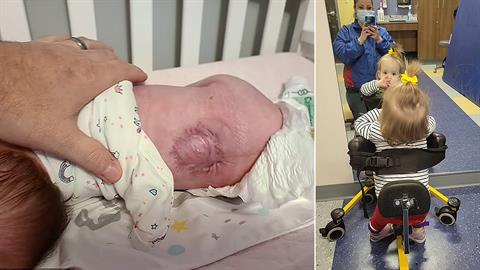 Είπαν πως η κόρη μας δεν θα περπατήσει - 19 μήνες μετά, κάνει τα πρώτα της βήματα