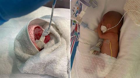 Προωράκι 623 γραμμαρίων έδωσε μάχη για να κρατηθεί στη ζωή και τα κατάφερε!