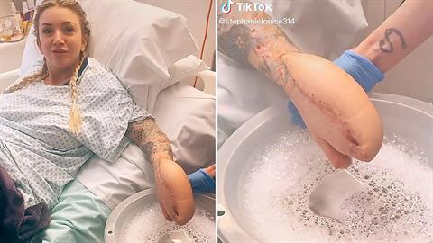 34χρονη μαμά με «χέρι-καρχαρία» δίνει καθημερινά μάχη για τη ζωή της!