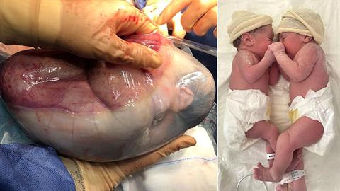 Διδυμάκι γεννήθηκε μέσα στον αμνιακό σάκο - συμβαίνει 1 στις 80.000