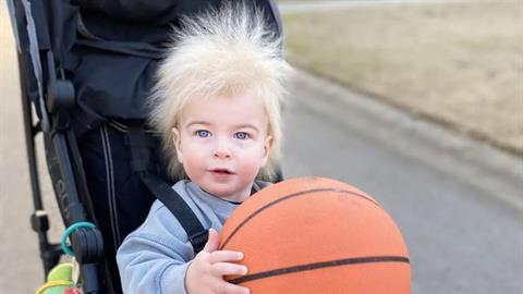 Μωρό γεννιέται με Σύνδρομο Αχτένιστων Μαλλιών και οι φωτογραφίες του θα σου φτιάξουν τη μέρα!