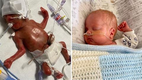 Γεννήθηκε στις 23 εβδομάδες αλλά πάλεψε με όλες του τις δυνάμεις και τα κατάφερε!