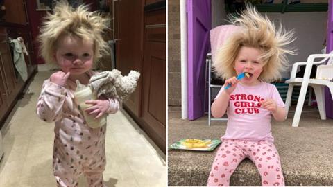 «Η κόρη μου έχει το Σύνδρομο Αχτένιστων Μαλλιών και είναι τέλεια!»