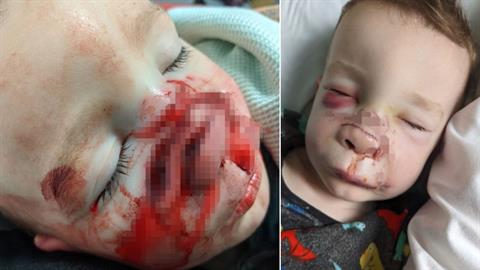 Σκύλος επιτέθηκε σε 2χρονο - το τραυμάτισε σοβαρά στο πρόσωπο
