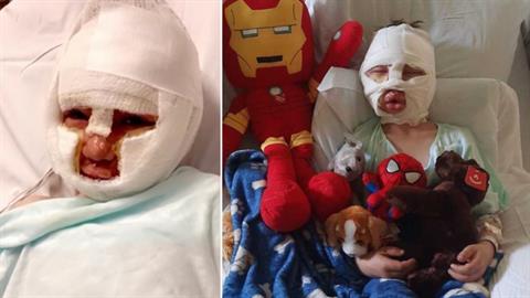 6χρονος παραλίγο να καεί ζωντανός από ακραίο bullying- του έβαλαν φωτιά!